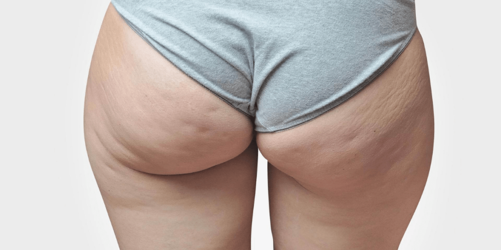 Cellulite: Definition, Causes, Prevention, and Treatment