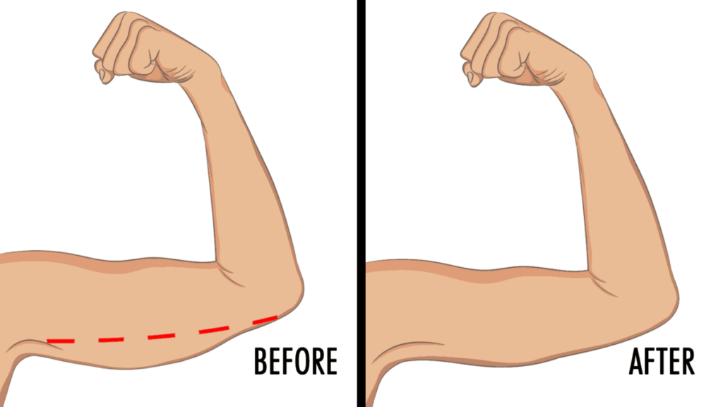How to lose underarm Fat